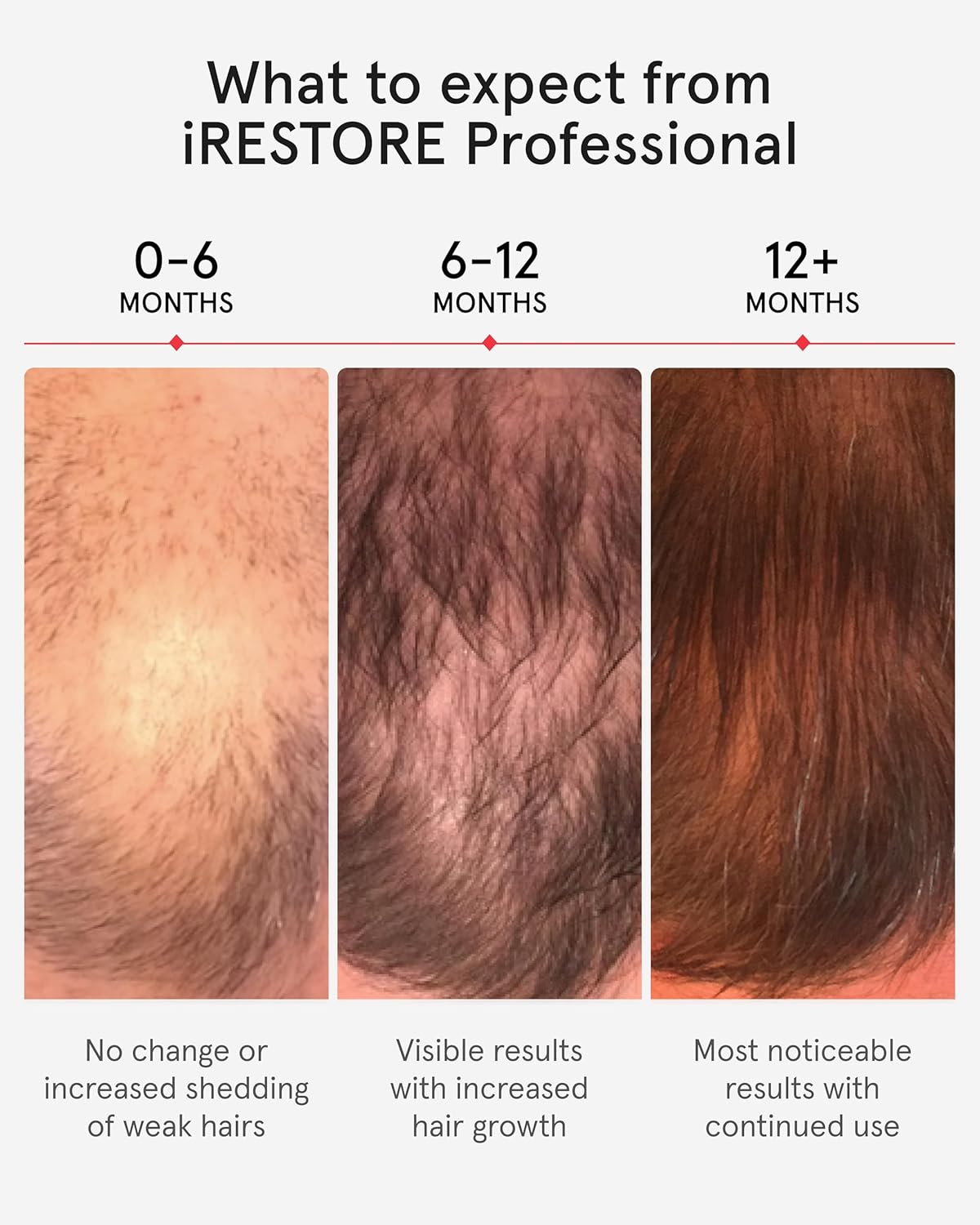 iRestore Professional 專業版雷射生髮安全帽 (282光束)